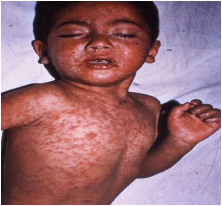 Trẻ em nhiễm bệnh sởi thường có triệu chứng gì?
